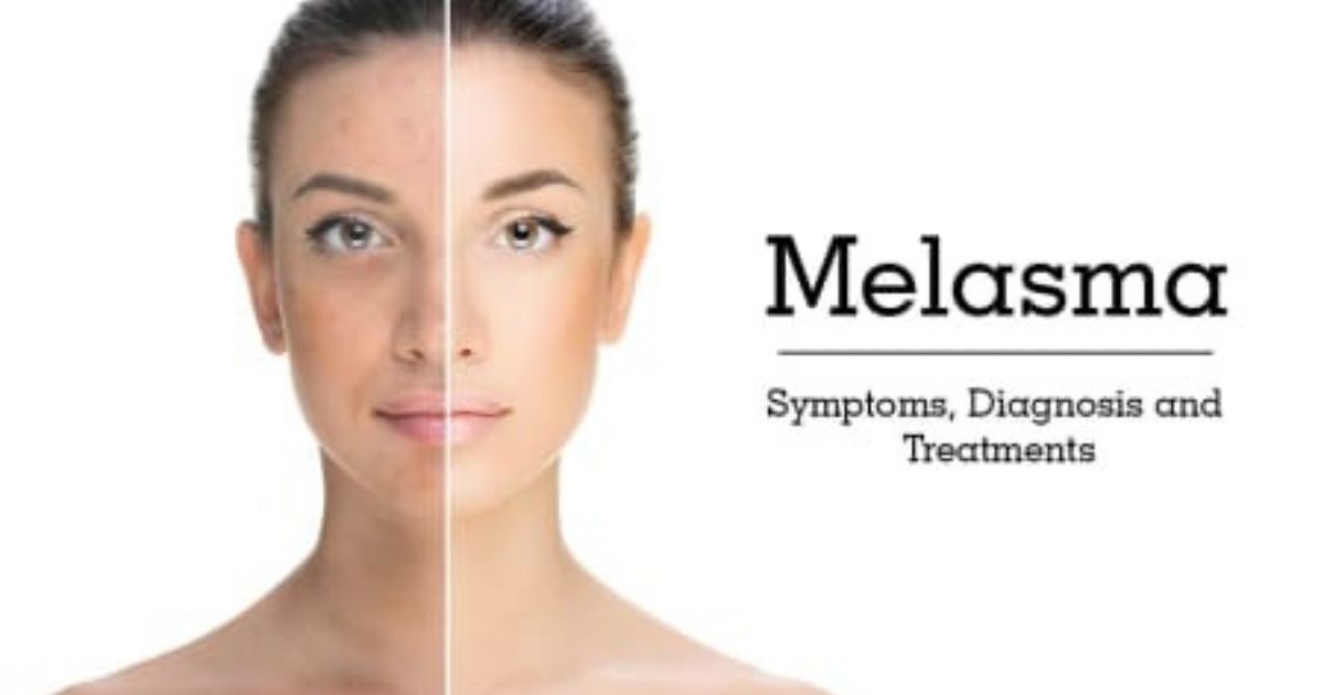 melasma causes